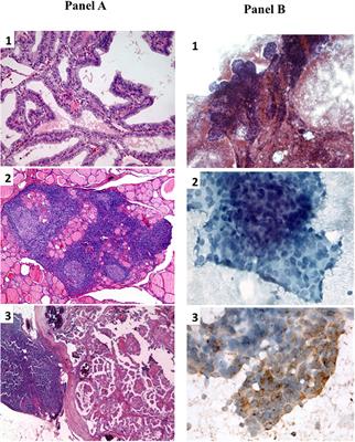 Frontiers | Lung Recurrence of Papillary Thyroid Cancer Diagnosed With